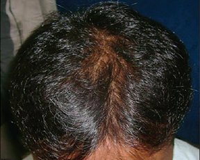 Adivasi Hair Oil - Day 30